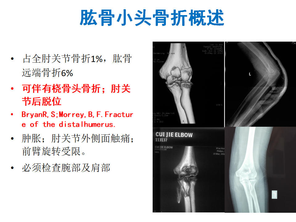 肱骨小头骨折临床治疗与手术技巧