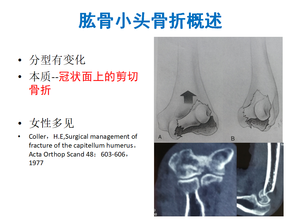 肱骨小头骨折临床治疗与手术技巧