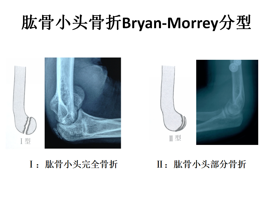 肱骨小头骨折临床治疗与手术技巧