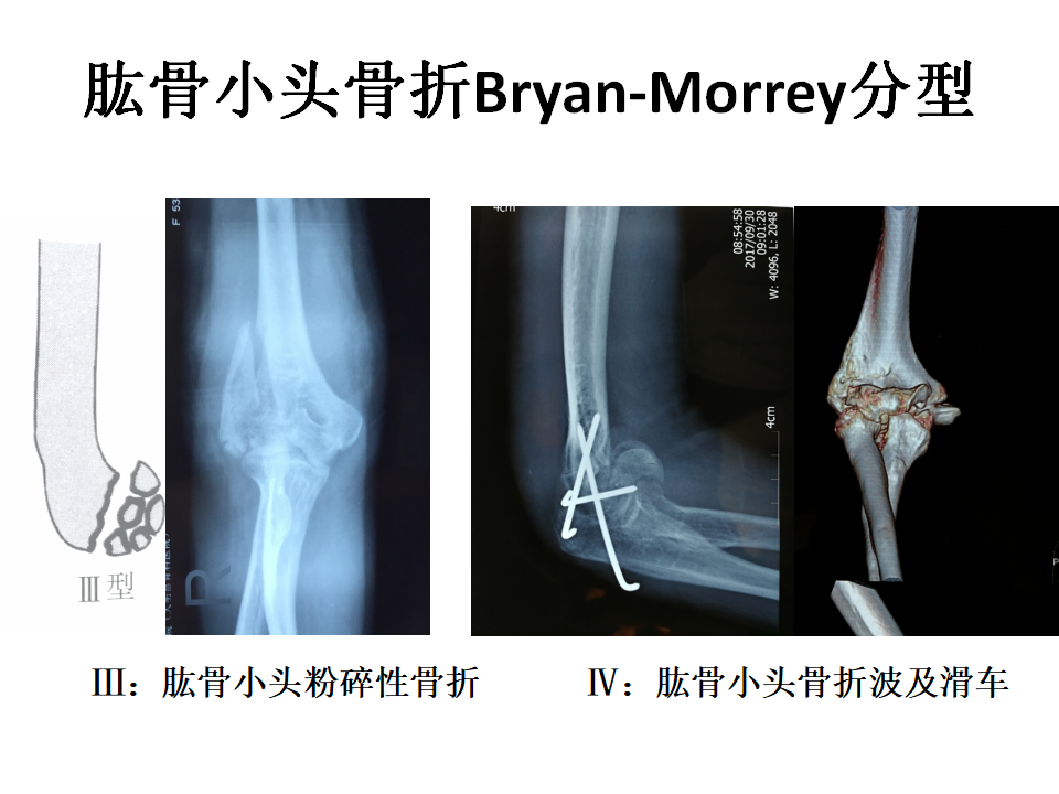 肱骨小头骨折临床治疗与手术技巧