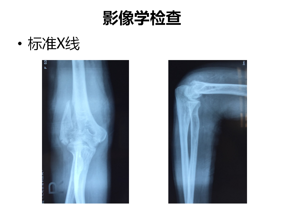 肱骨小头骨折临床治疗与手术技巧