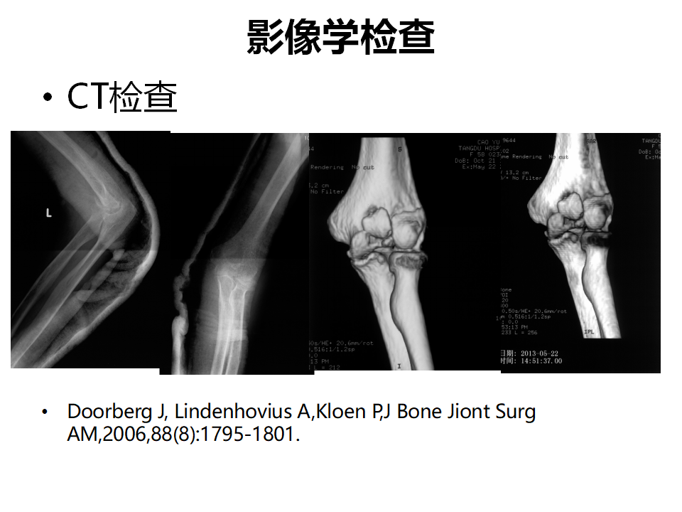 肱骨小头骨折临床治疗与手术技巧