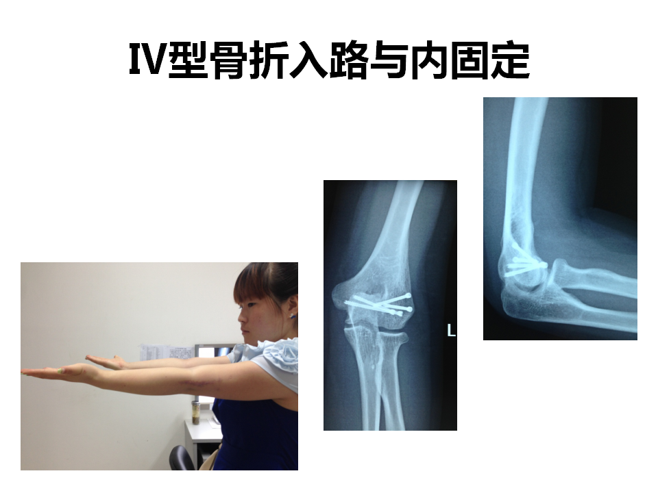 肱骨小头骨折临床治疗与手术技巧