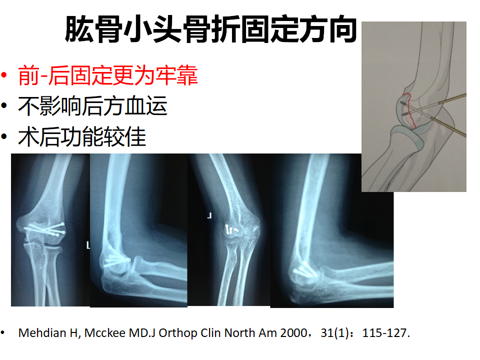 肱骨小头骨折临床治疗与手术技巧