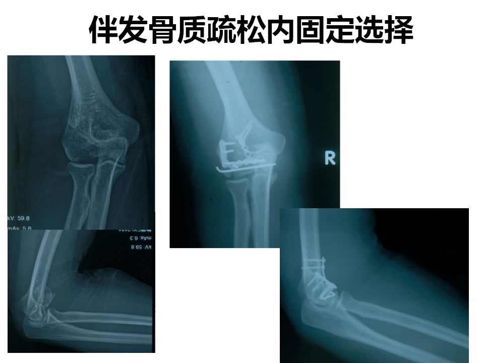 肱骨小头骨折临床治疗与手术技巧