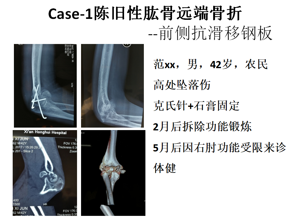 肱骨小头骨折临床治疗与手术技巧