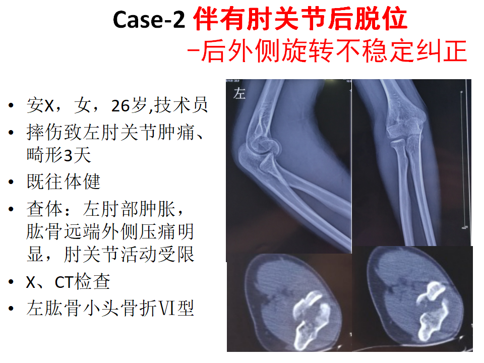 肱骨小头骨折临床治疗与手术技巧