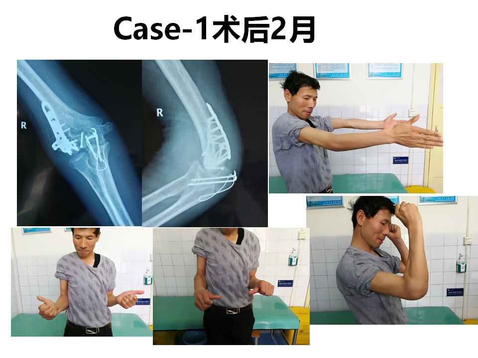 肱骨小头骨折临床治疗与手术技巧