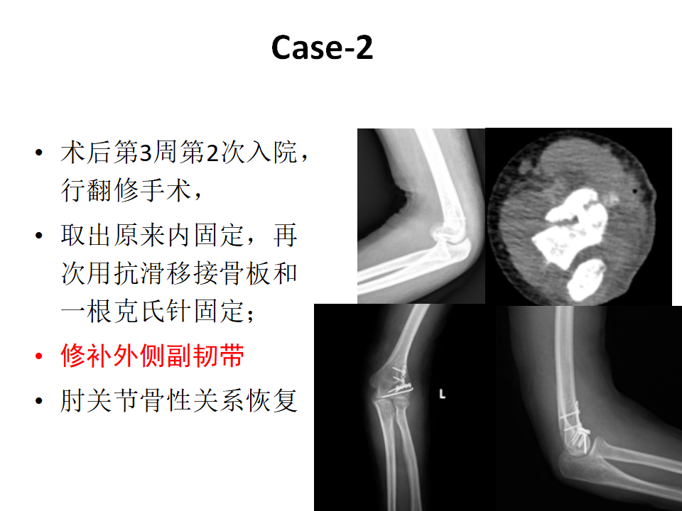 肱骨小头骨折临床治疗与手术技巧