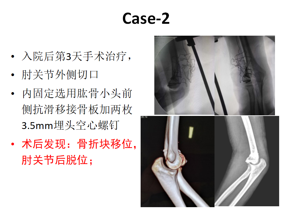 肱骨小头骨折临床治疗与手术技巧