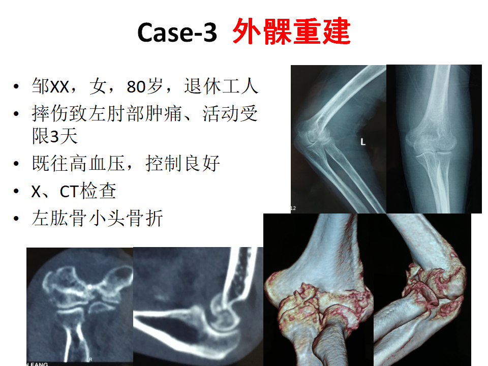 肱骨小头骨折临床治疗与手术技巧