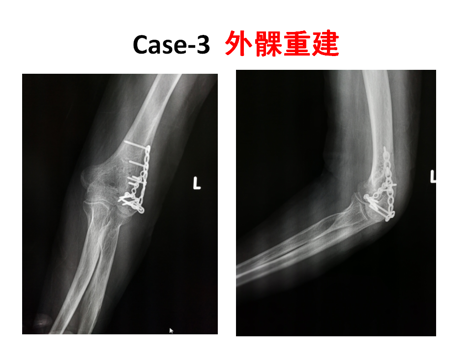 肱骨小头骨折临床治疗与手术技巧