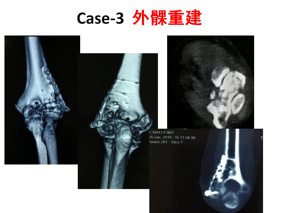 肱骨小头骨折临床治疗与手术技巧