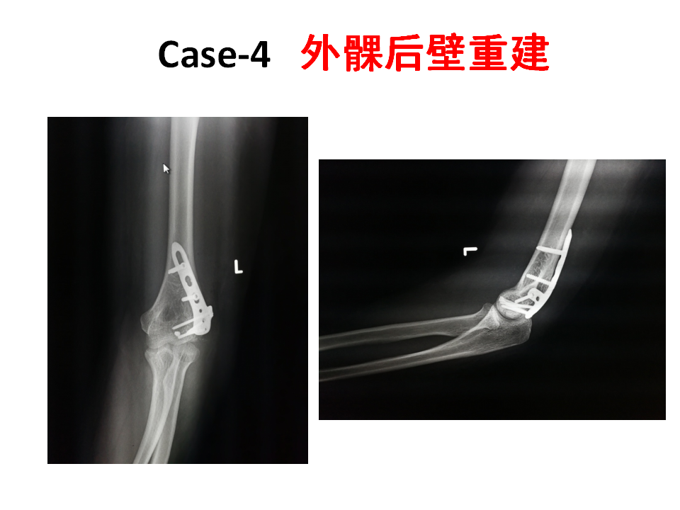 肱骨小头骨折临床治疗与手术技巧