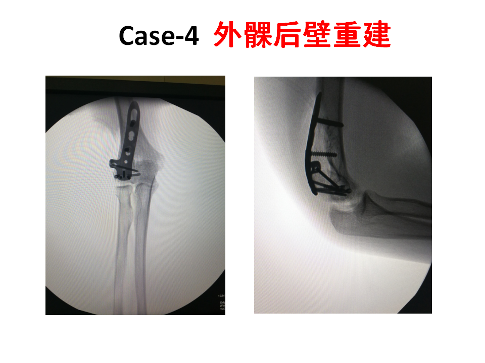 肱骨小头骨折临床治疗与手术技巧