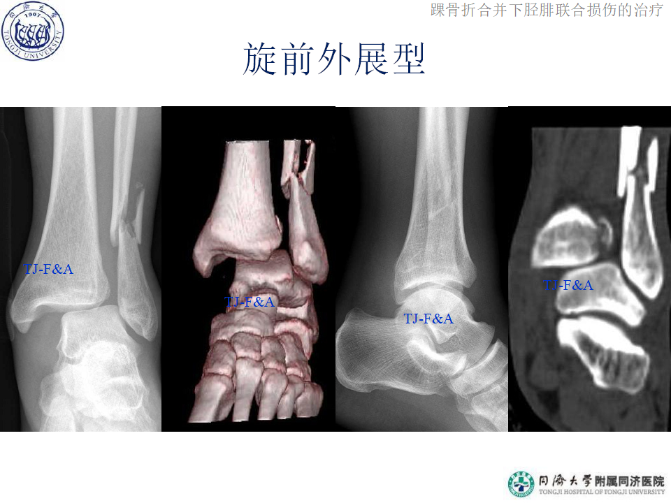 踝骨折合并下胫腓联合损伤的诊断与治疗