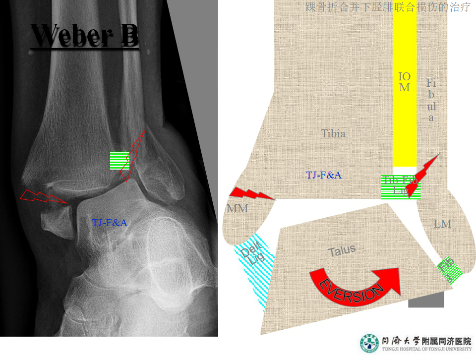 踝骨折合并下胫腓联合损伤的诊断与治疗