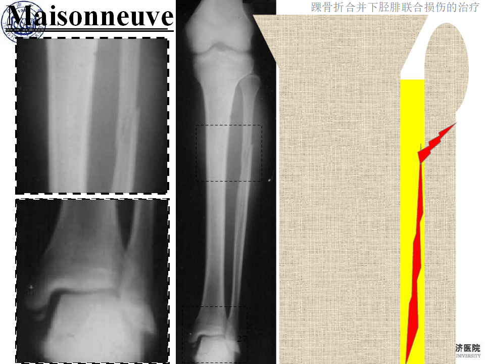 踝骨折合并下胫腓联合损伤的诊断与治疗