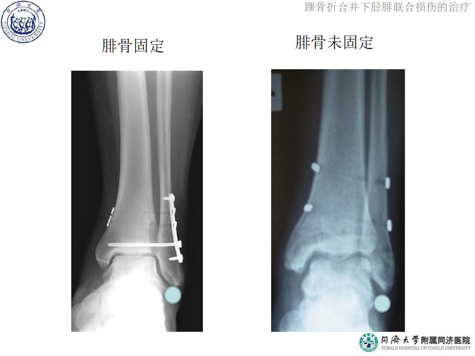 踝骨折合并下胫腓联合损伤的诊断与治疗