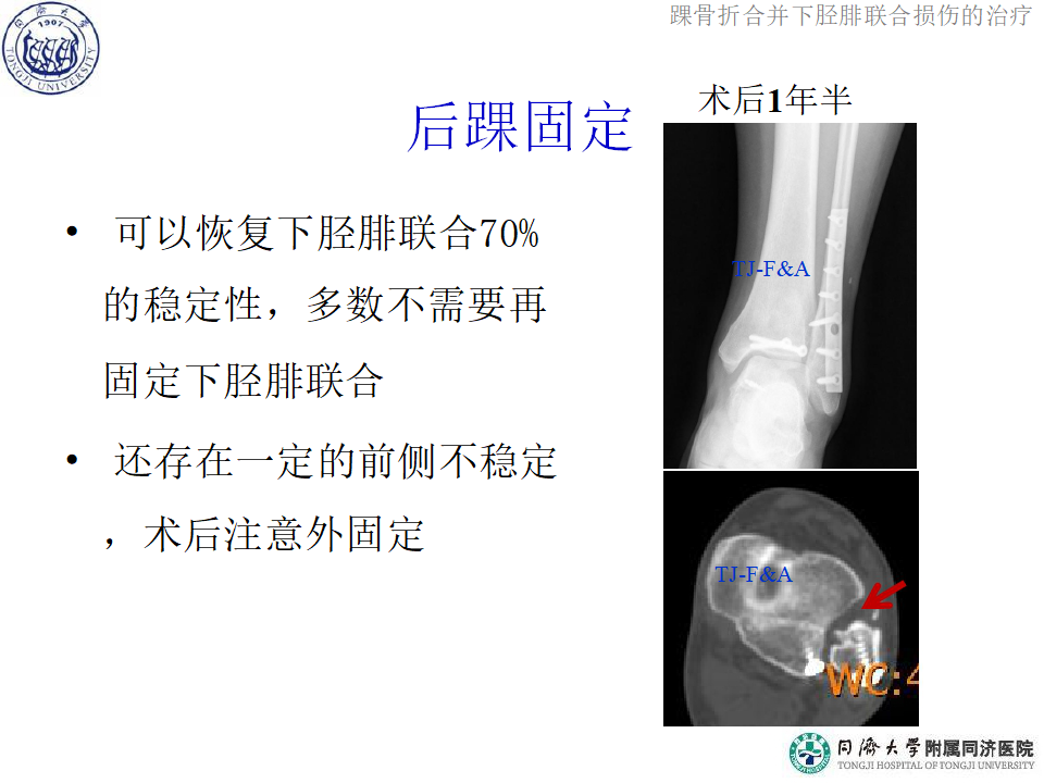 踝骨折合并下胫腓联合损伤的诊断与治疗