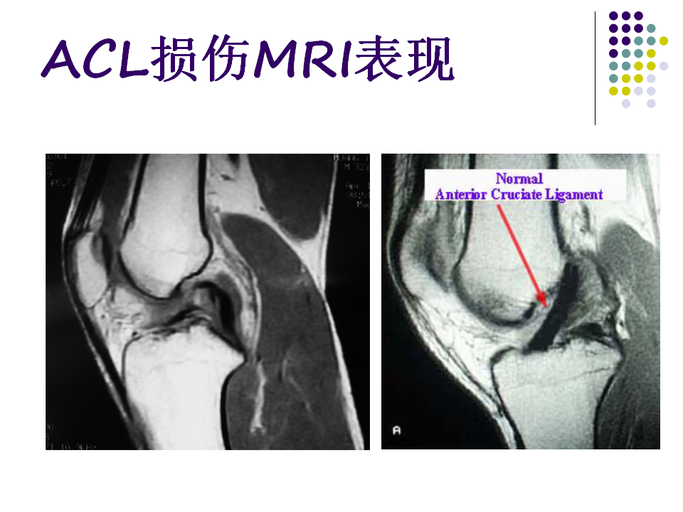 膝关节前交叉韧带损伤诊断与治疗