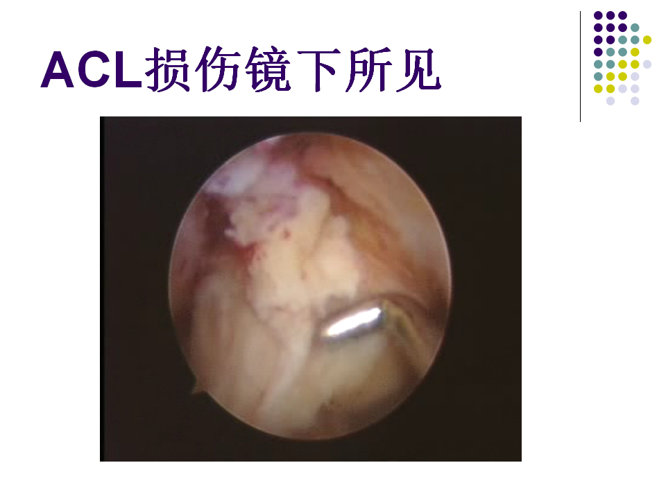 膝关节前交叉韧带损伤诊断与治疗