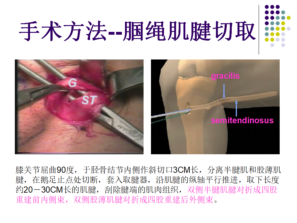 膝关节前交叉韧带损伤诊断与治疗