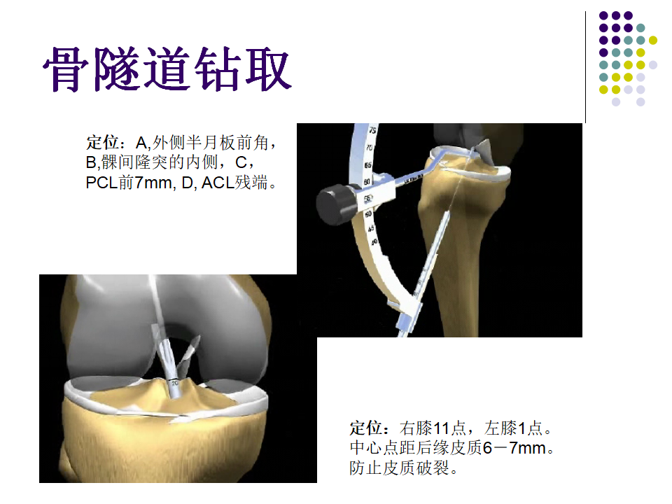 膝关节前交叉韧带损伤诊断与治疗