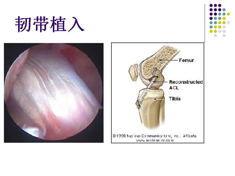 膝关节前交叉韧带损伤诊断与治疗