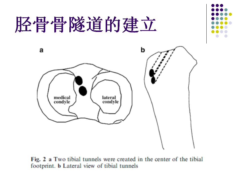 膝关节前交叉韧带损伤诊断与治疗