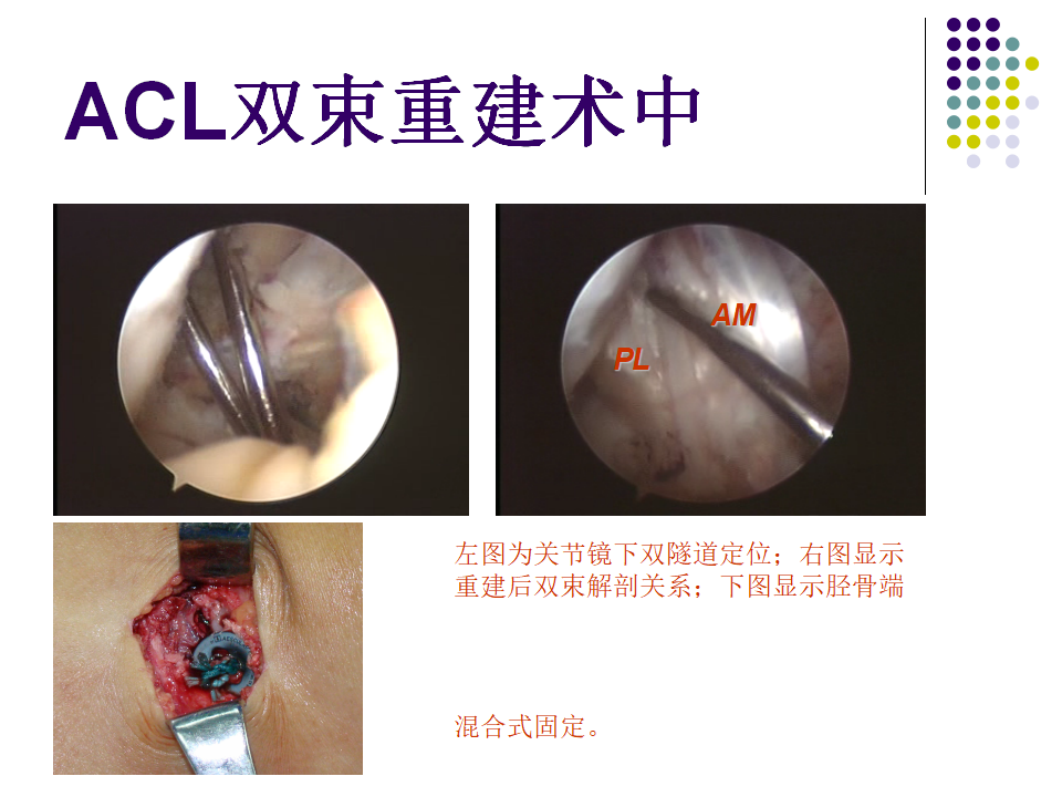 膝关节前交叉韧带损伤诊断与治疗