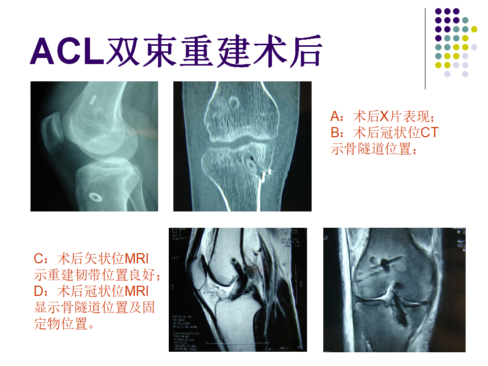 膝关节前交叉韧带损伤诊断与治疗