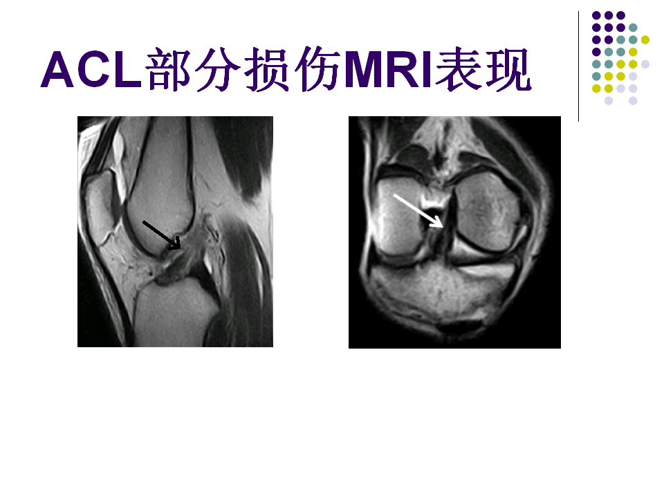 膝关节前交叉韧带损伤诊断与治疗