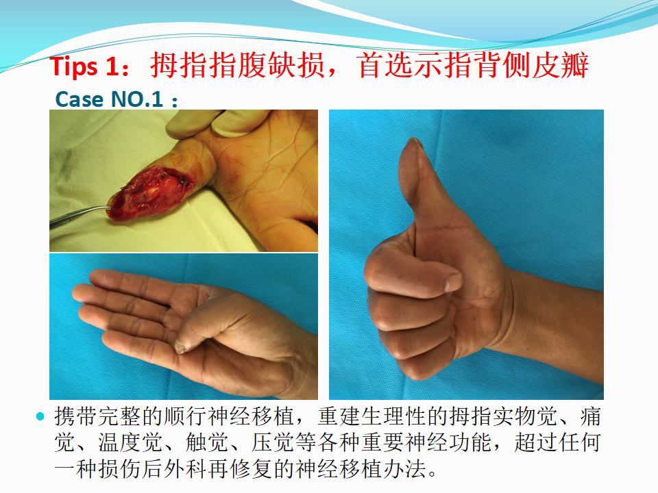 手指创面皮瓣修复的六项原则及推荐建议