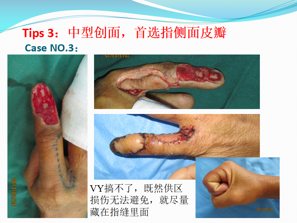 手指创面皮瓣修复的六项原则及推荐建议