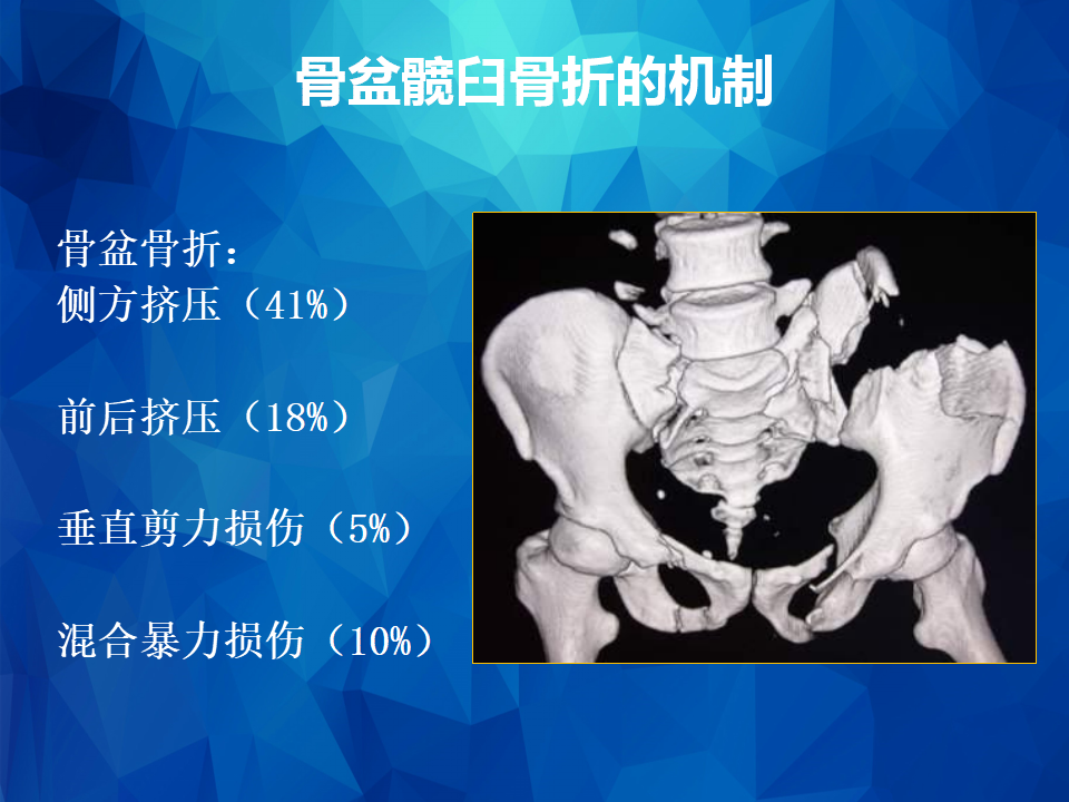 Stoppa及其改良入路治疗骨盆髋臼骨折