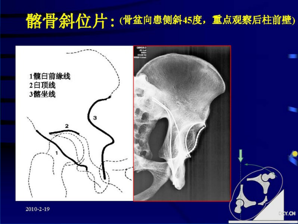 Stoppa及其改良入路治疗骨盆髋臼骨折