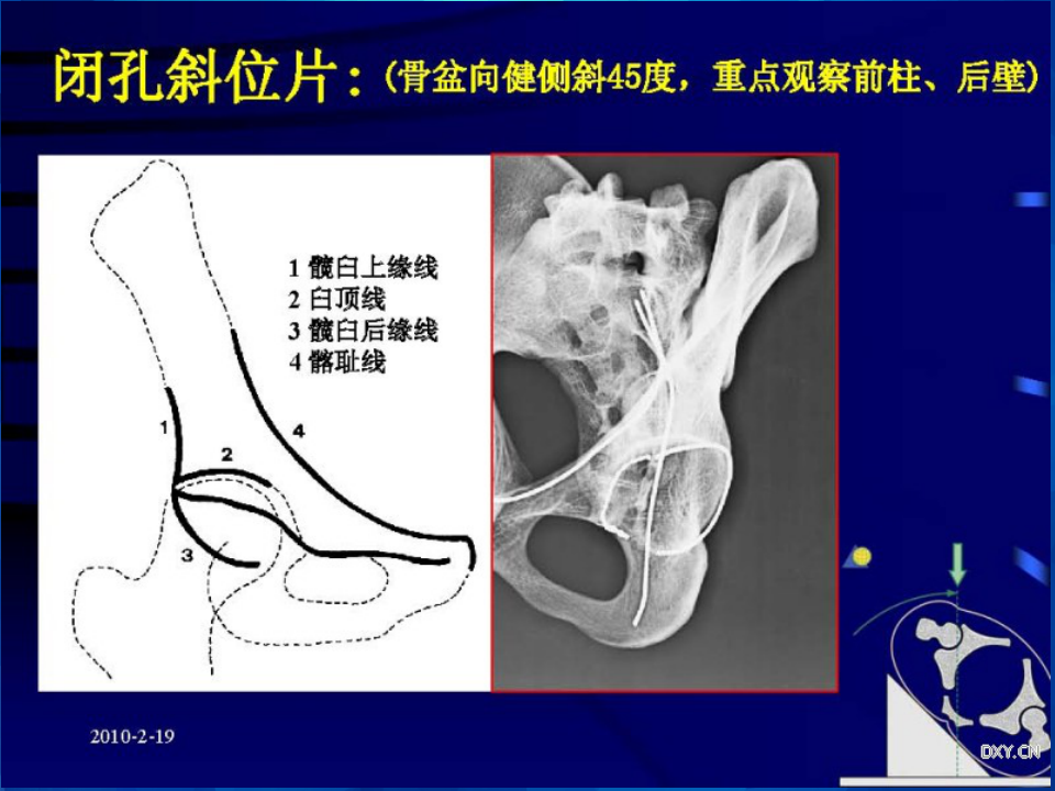 Stoppa及其改良入路治疗骨盆髋臼骨折