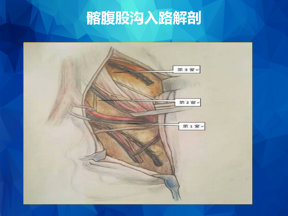 Stoppa及其改良入路治疗骨盆髋臼骨折