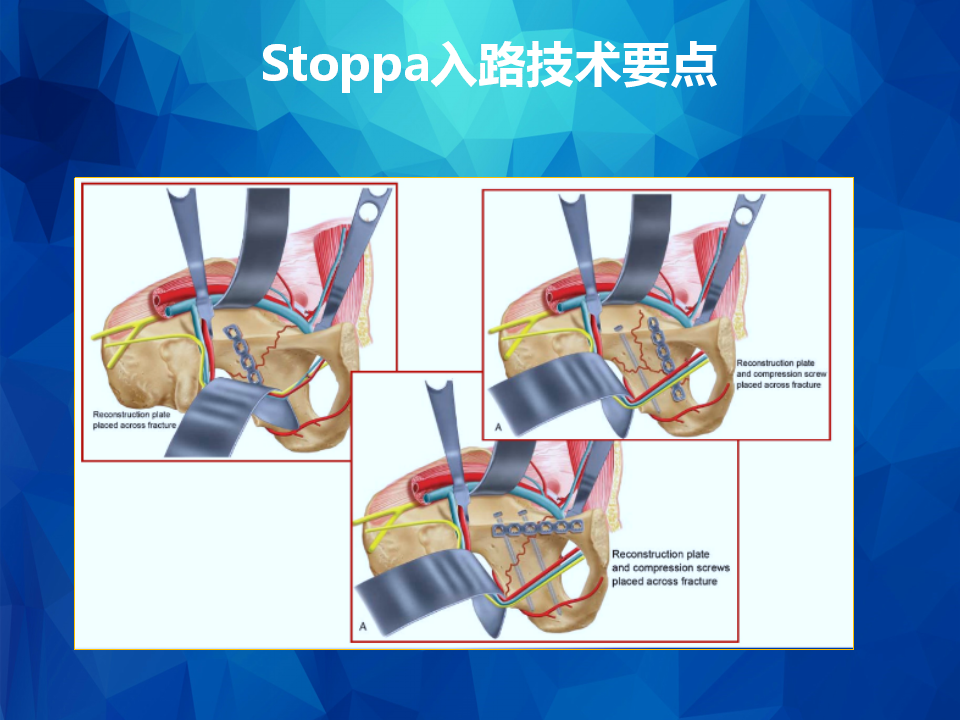 Stoppa及其改良入路治疗骨盆髋臼骨折