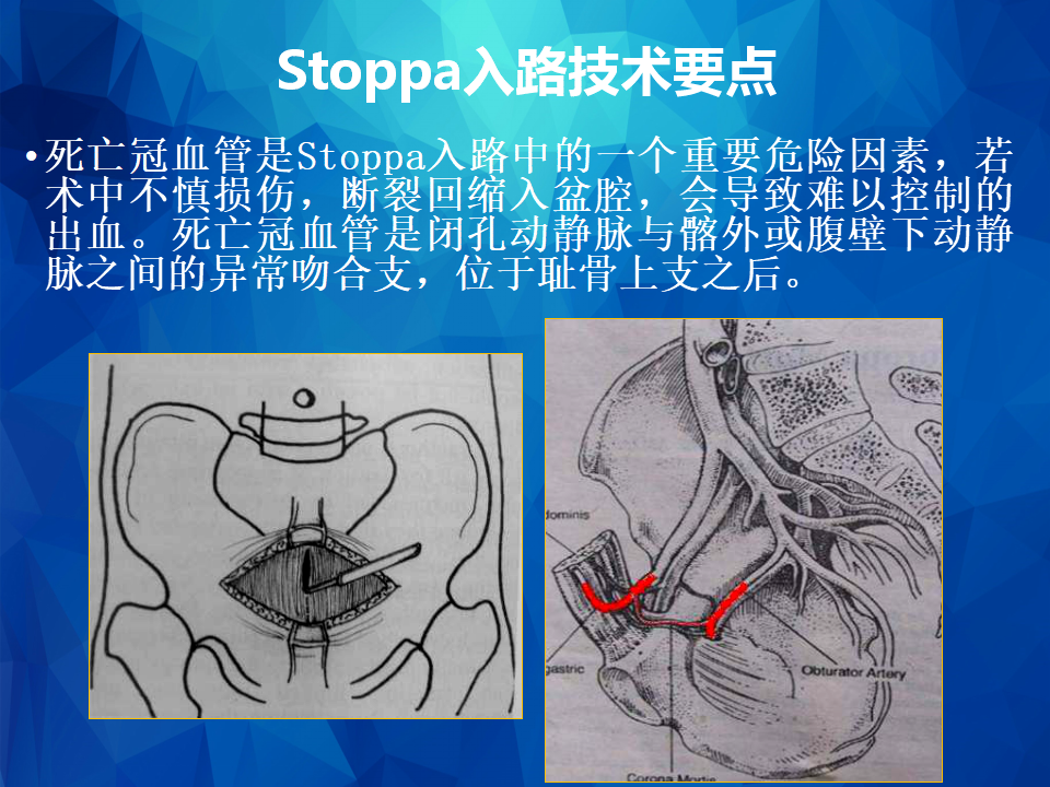 Stoppa及其改良入路治疗骨盆髋臼骨折