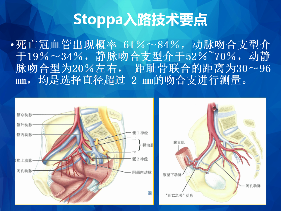 Stoppa及其改良入路治疗骨盆髋臼骨折