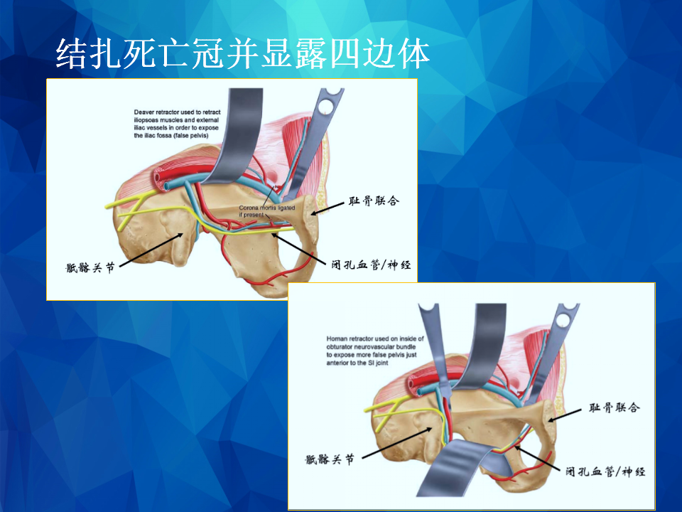 Stoppa及其改良入路治疗骨盆髋臼骨折