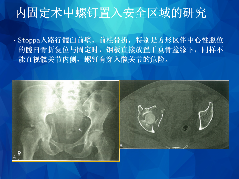 Stoppa及其改良入路治疗骨盆髋臼骨折