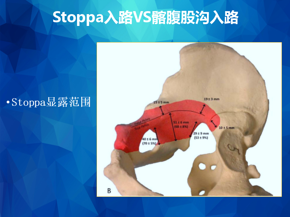 Stoppa及其改良入路治疗骨盆髋臼骨折