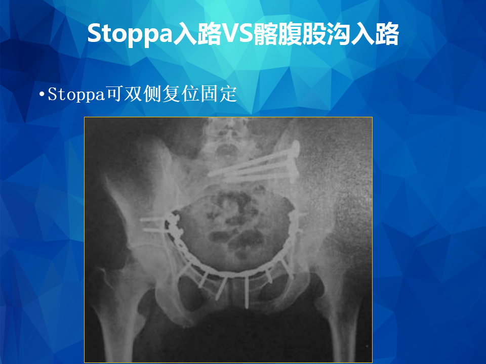 Stoppa及其改良入路治疗骨盆髋臼骨折