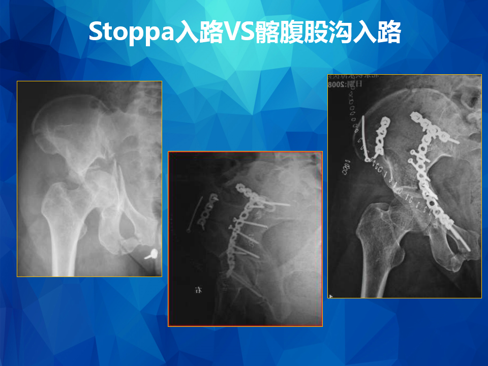 Stoppa及其改良入路治疗骨盆髋臼骨折