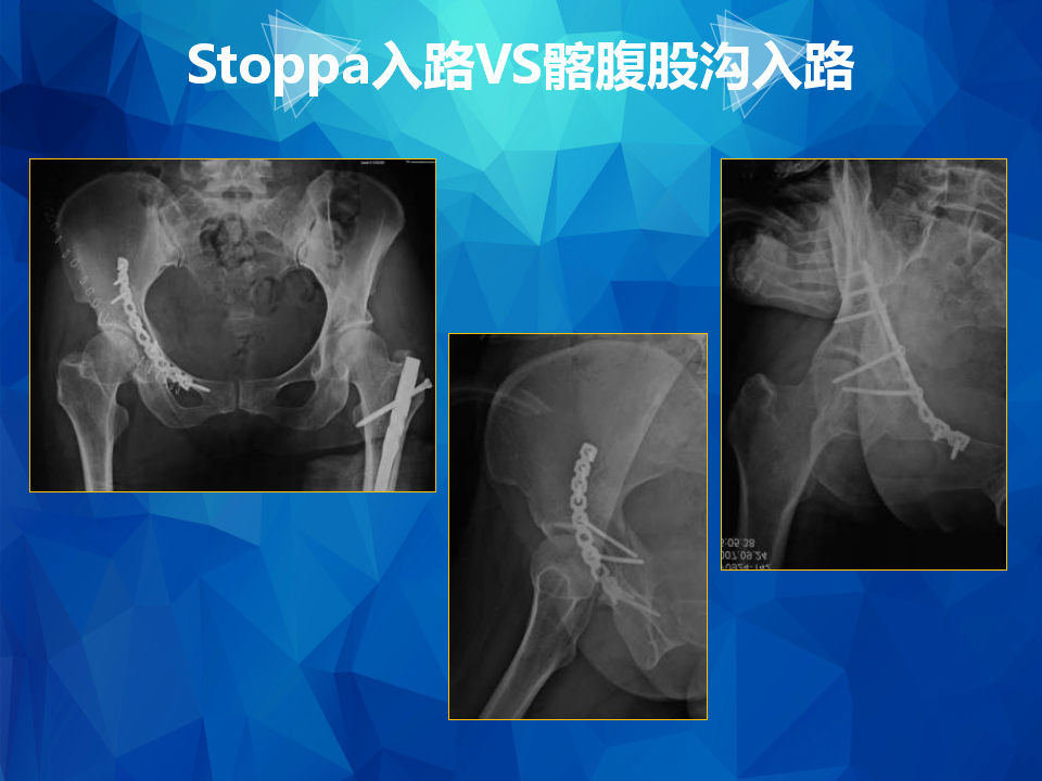 Stoppa及其改良入路治疗骨盆髋臼骨折