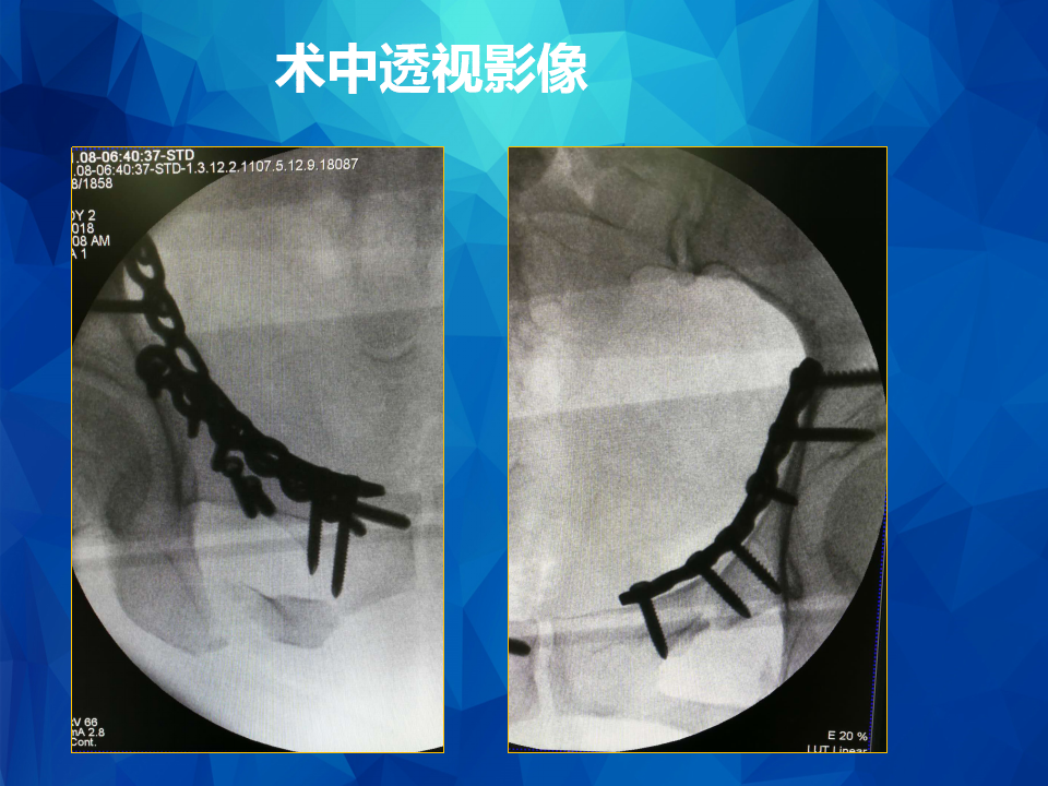 Stoppa及其改良入路治疗骨盆髋臼骨折