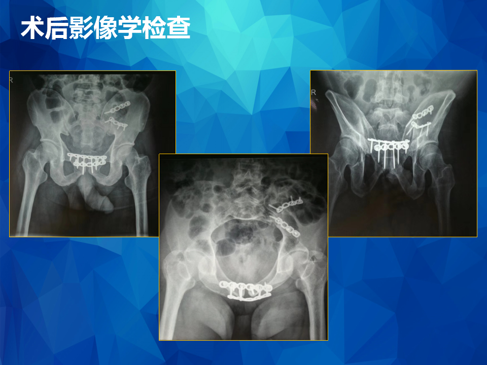 Stoppa及其改良入路治疗骨盆髋臼骨折